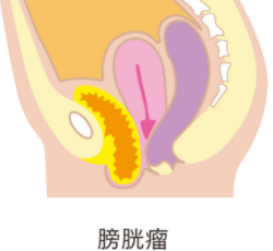 膀胱瘤の図