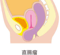 直腸瘤の図